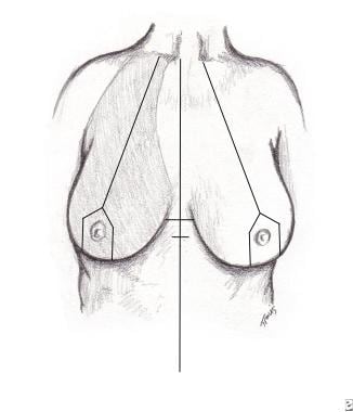 Central pedicle breast reduction. Preoperative ant