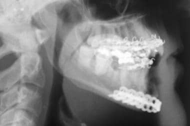 Mandibular fracture. Lateral view. 