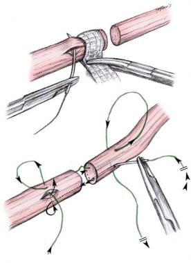 Kirchmayr tendon laceration repair suture techniqu