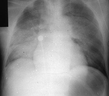 Heroin-related noncardiogenic pulmonary edema. 