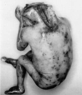 Autopsy specimen on a child with anencephaly. This