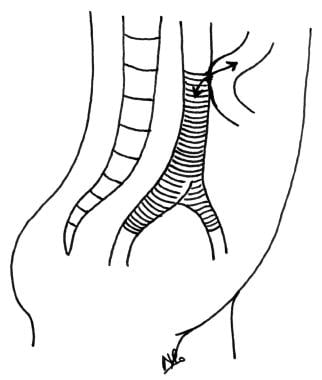 Aortoenteric fistula demonstrating a direct connec