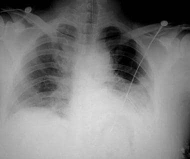 left hemothorax x ray