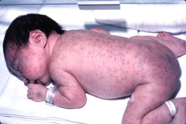 Immune thrombocytopenia. An infant born with neona