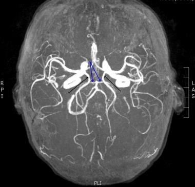 Posterior Cerebral Artery Stroke Mri Sexiz Pix | Sexiz Pix