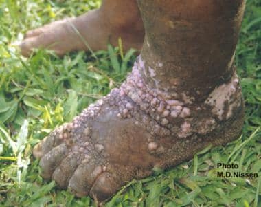 Filariasis. This is a close-up view of the unilate