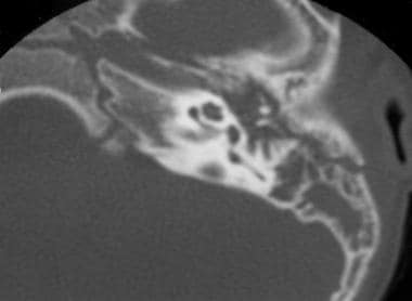 Longitudinal temporal bone fracture (courtesy of A