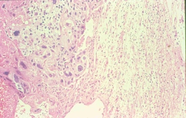 In this microphotograph of a choriocarcinoma metas