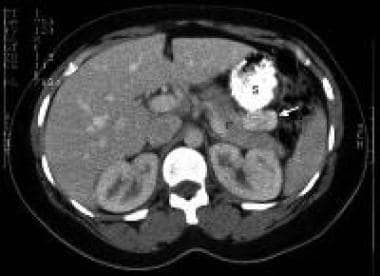 CT scan image with oral and intravenous contrast i