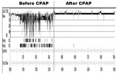 Obstructive Sleep Apnea (OSA) Treatment & Management: Approach  Considerations, Nasal CPAP Therapy, BiPAP Therapy