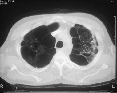 Emphysema. A computed tomography scan shows emphys