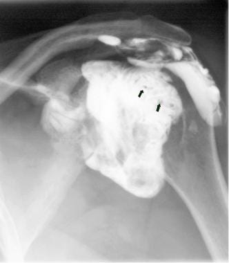 Complete rotator cuff tear with presence of contra