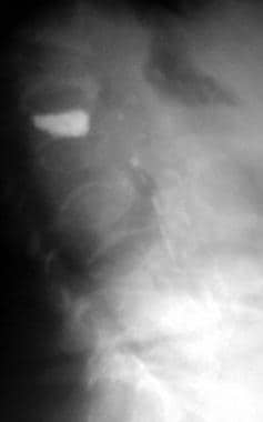 Osteoporosis. Lateral radiograph demonstrates mult
