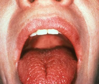 Dryness of the mouth and tongue due to lack of sal