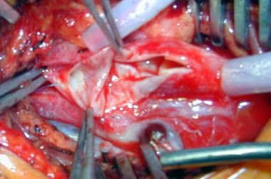 Carotid artery following endarterectomy and prior 
