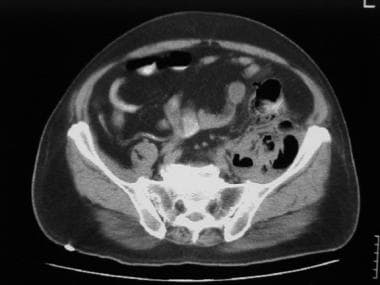 A lower CT scan slice from a 62-year-old man who r