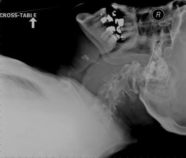 Lateral soft tissue radiograph of an elderly patie