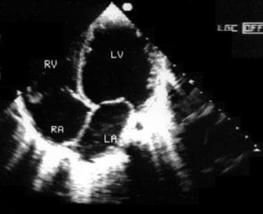 Echocardiography findings. Echocardiography shows global hypokinesia on