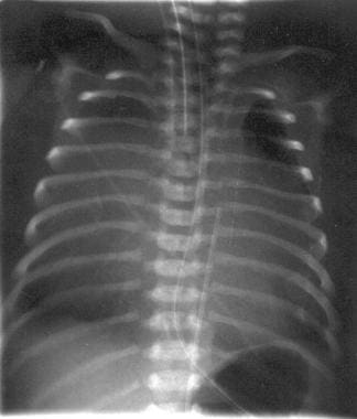 Characteristic chest radiograph of a neonate with 