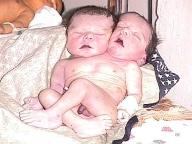 This set of conjoined twins was a stillbirth. Pren