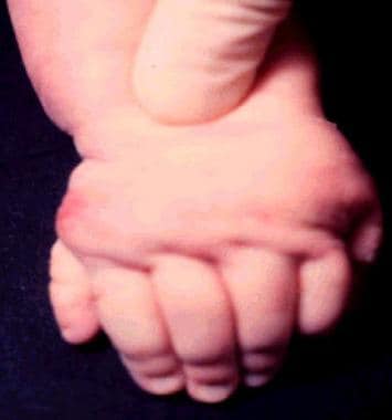 Postaxial多指趾畸形。