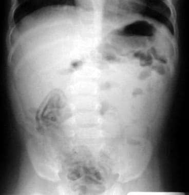 Pneumatosis intestinalis. Photo courtesy of Loren 