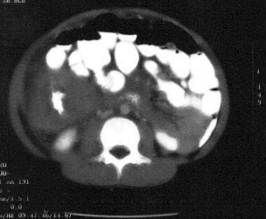 Non-Hodgkin lymphoma of the terminal ileum. Note t