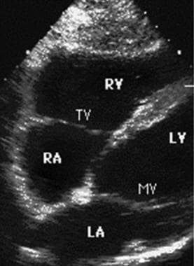 Ultrasound image of subxiphoid 4-chamber view. 