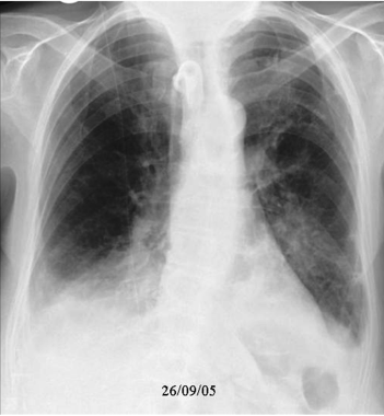 A case of evolving aspiration pneumonia (3 of 4 im