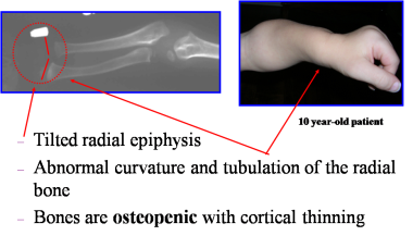 Skeletal/joint disease - hands. The epiphyseal inv