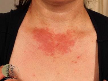 Polymorphous light eruption on the chest. Courtesy