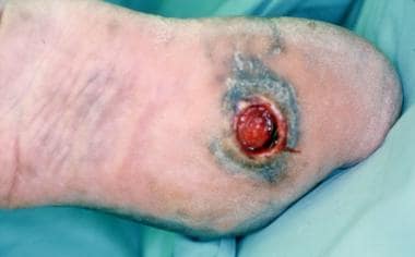 Ulceration on plantar surface of the foot secondar