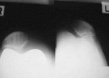 Total knee arthroplasty. Skyline views of both kne