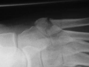 Fifth metatarsal stress fracture. 