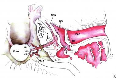 Facial nerve electrodiagnostics for patients with facial palsy: a