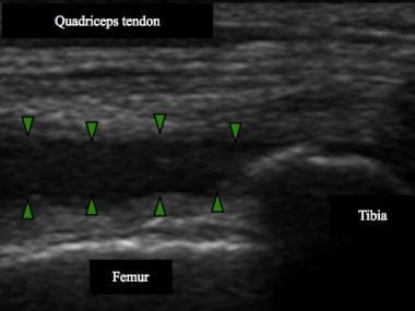 Note knee effusion in suprapatellar recess (bounde