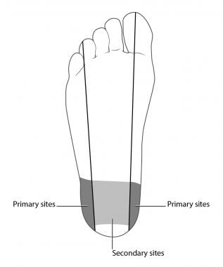 Heel Sticks Overview Periprocedural Care Technique