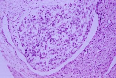 Pathology of Uterus Smooth Muscle Tumors. Vascular