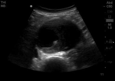 Short-axis view of an abdominal aortic aneurysm ro