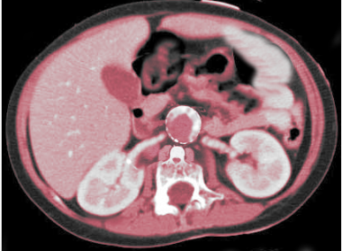 CT scan of abdomen showing calcified abdominal aor