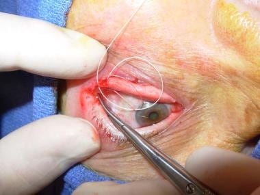 4-0 polyglactin suture is then passed through peri