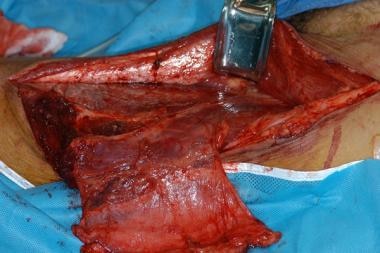 Anterolateral thigh flap elevation with lateral ci