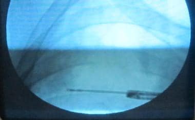 Fluoroscopic image of transbronchial biopsy forcep