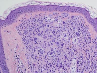 Multinucleate nevus cells, "ancient change," in an