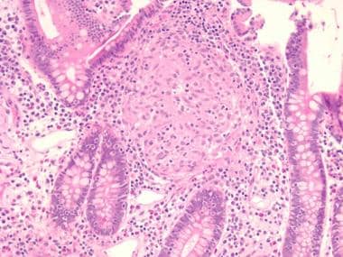 A granuloma in the mucosa of a Crohn disease patie