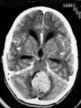 Medulloblastoma. Following intravenous injection o