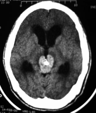 Axial, post-contrast CT demonstrates an enhancing 