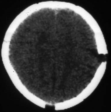 Axial computed tomography scan shows a growing sku