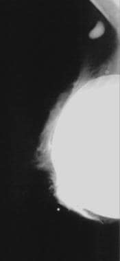 Mediolateral oblique mammogram shows extracapsular