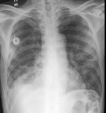 Chest radiograph in a patient with a history of an